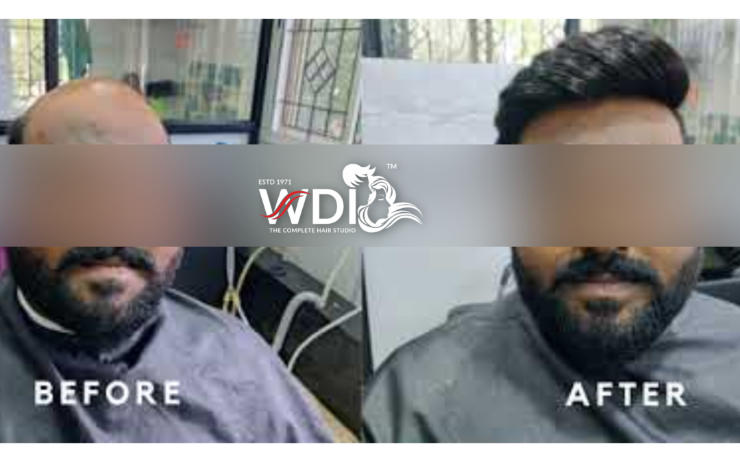 Hair Wigs and Hair Fixing Services in Bangalore WDI Hair Studio