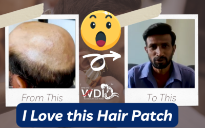 Hair Patch in Bangalore: A Solution for Hair Loss