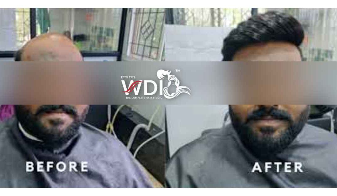 Hair Wigs and Hair Fixing Services in Bangalore