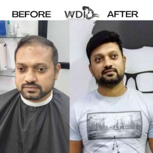hair patch